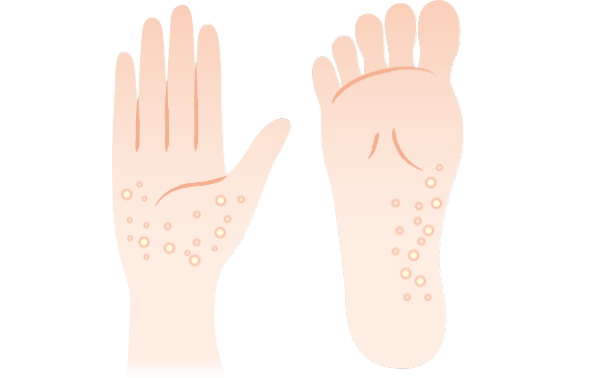 イラスト：手のひらと足の裏に水疱・膿疱ができているイメージ