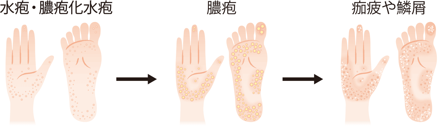 イラスト：掌蹠（手のひら、足の裏）の症状の進行イメージ。水疱・膿疱化水疱が生じ、膿疱となり、やがて痂疲や鱗屑が見られるようになる
