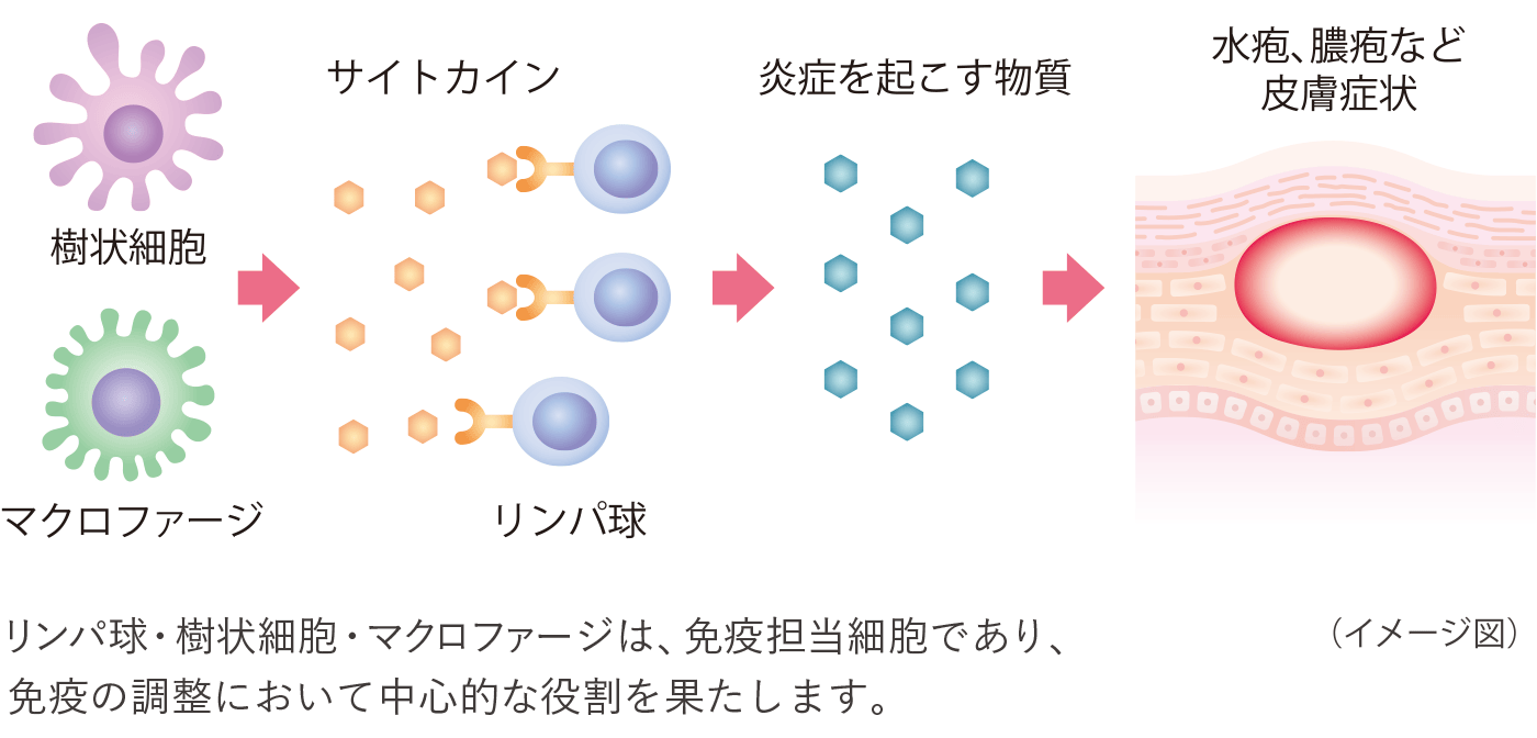 イラスト：掌蹠膿疱症が起こる仕組みのイメージ図です。