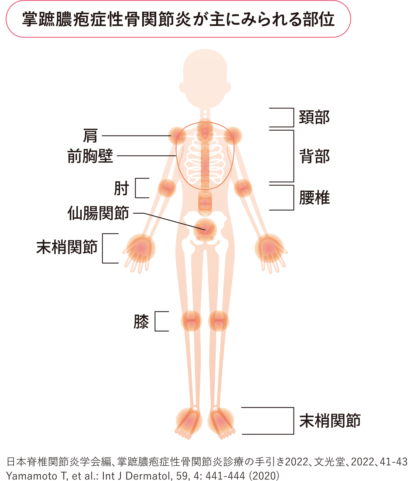 イラスト：掌蹠膿疱症性骨関節炎が主にみられる部位（頚部・背部・腰椎・肩・前胸壁・肘・仙腸関節・手の末梢関節・膝・足の末梢関節）を示した図。
出典：日本脊椎関節炎学会編、掌蹠膿疱症性骨関節炎診療の手引き2022、文光堂、2022、41-43
Yamamoto T, et al.: Int J Dermatol, 59, 4: 441-444 (2020)