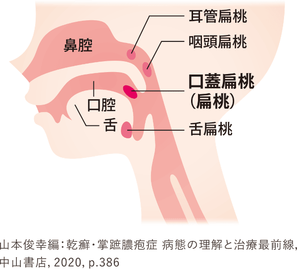 イラスト：口蓋扁桃（扁桃）の位置のイメージ。鼻腔・口腔・舌・耳管扁桃・咽頭扁桃・口蓋扁桃（扁桃）・舌扁桃の位置関係をを示した図。
出典：山本俊幸編：乾癬・掌蹠膿疱症 病態の理解と治療最前線，中山書店，2020，.386