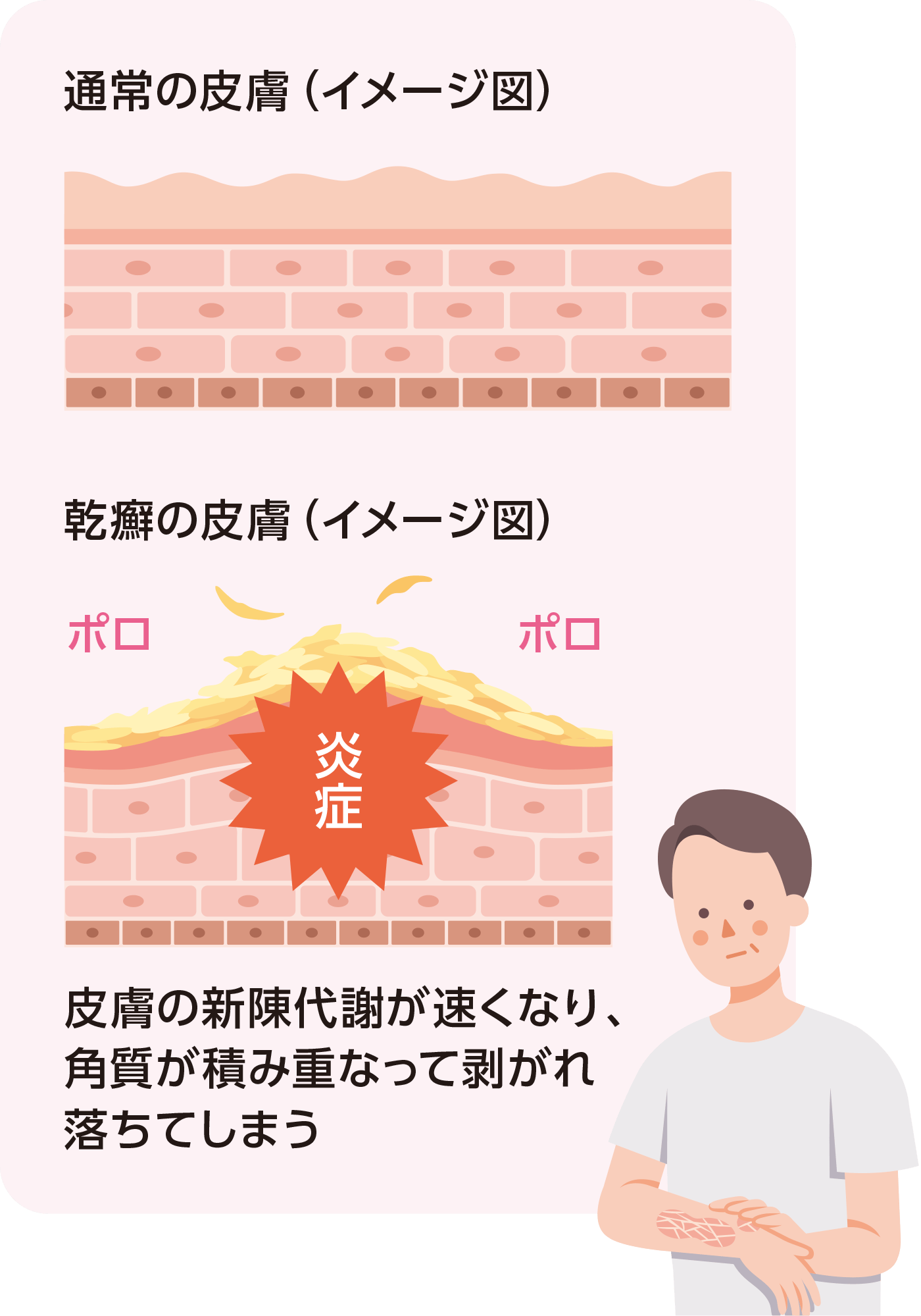 通常の皮膚と乾癬の皮膚の比較(イメージ図)